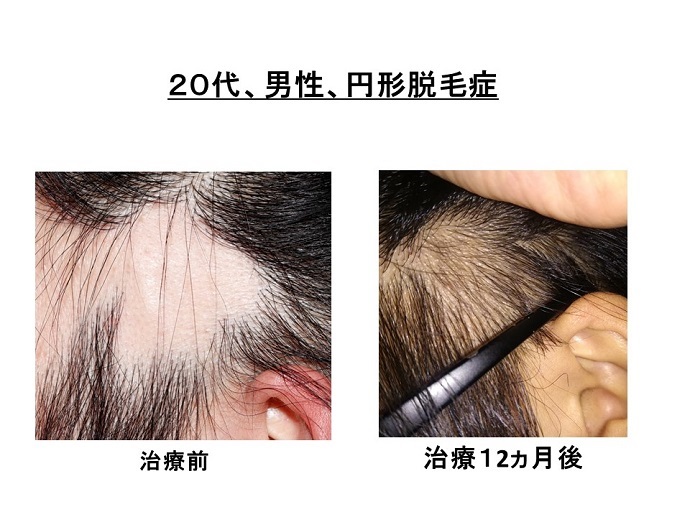 円形脱毛症　病院